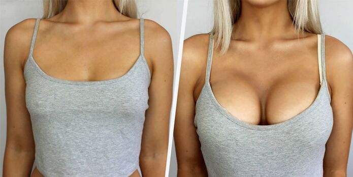 prieš ir po plastinės krūtų didinimo operacijos