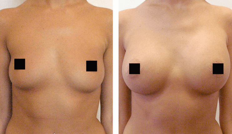 krūtys prieš ir po padidinimo hialurono rūgštimi