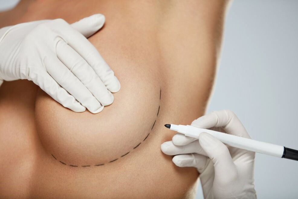 periareolinė krūties mammoplastika
