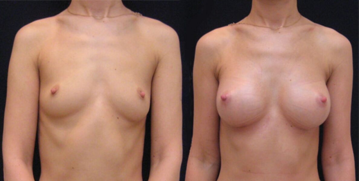 krūtis prieš ir po endoskopinio didinimo