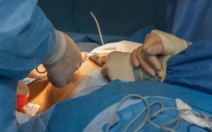 kaip atliekama krūtų didinimo operacija
