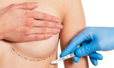 Submamaras prieiga prie krūtų padidinimo implantams